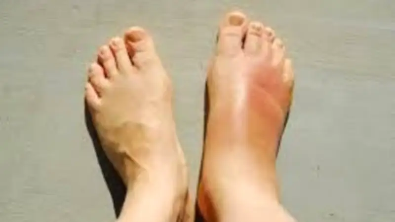 البقدونس: عشبة طبيعية لعلاج احتباس السوائل والضغط وفقر الدم