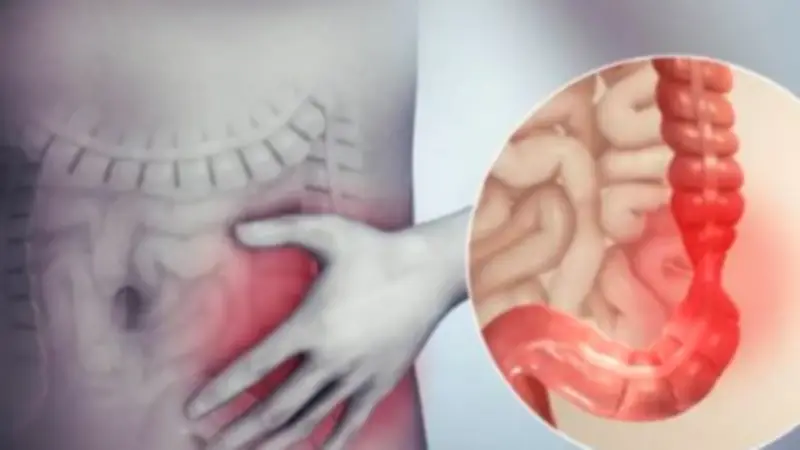 التهاب القولون التقرحي: أسبابه وأبرز أعراضه وكيفية التعامل معه