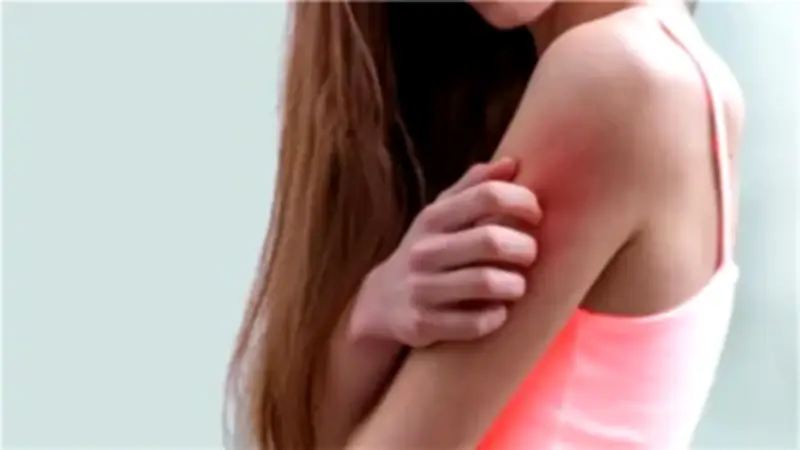 البلاجرا: مرض نقص فيتامين B3 الذي يهدد الجلد والأعصاب والهضم