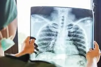 ماليزيا ترصد 10 بؤر جديدة لمرض السل في 7 ولايات وتعلن حالة تأهب صحي