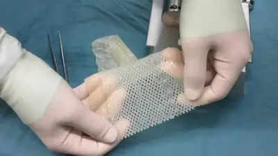 أستاذ جلدية: نقل الجلد بين البشر دون توافق مناعي مستحيل طبياً