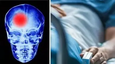 احذر من هذه العوامل الخطيرة التي تزيد من احتمالية الإصابة بجلطة الدماغ