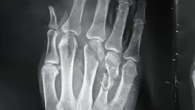 نجاح جراحة معقدة بمستشفى قنا العام تنقذ يد شاب من البتر بعد حادث سير