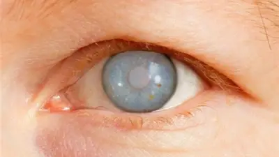 الجلوكوما: المرض الصامت الذي يهدد البصر دون سابق إنذار