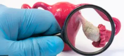 دراسة علمية تزف بشرى سارة بشأن علاج سرطان المبيض