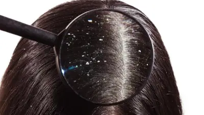 وصفات طبيعية فعالة لعلاج قشرة الشعر في المنزل دون شامبو طبي