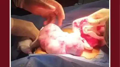 فريق طبي بجامعة طنطا ينجح في استئصال ورم خبيث يزن 2 كيلو من طفلة عمرها 10 سنوات