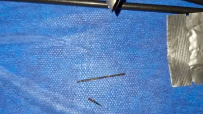 فريق طبي ينجح في استخراج إبرة خياطة من بطن فتاة بأسيوط بعد 40 يوما