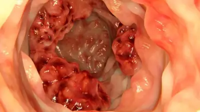 5 علامات تحذيرية لا يجب تجاهلها: أعراض سرطان القولون التي قد تشبه مشاكل هضمية بسيطة