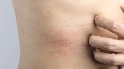 7 خطوات فعالة لحماية المناطق الحساسة من التهيج والعدوى خلال فصل الصيف