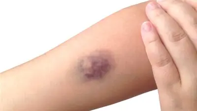 هل البقع الزرقاء أو الحمراء بالجسم تشير إلى أمراض القلب؟ استشاري يوضح الأسباب والعلاقة