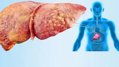 طريقة ثورية لزراعة الكبد تخلص المرضى من أدوية تثبيط المناعة لسنوات