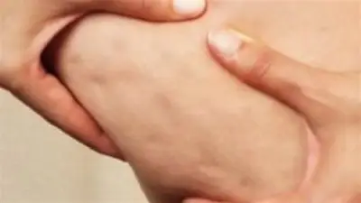 وصفات طبيعية فعالة لتقليل السيلوليت وتحسين ملمس البشرة في المنزل