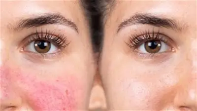 كيفية علاج تهيج البشرة بعد إزالة الشعر بالواكس: نصائح من خبيرة تجميل