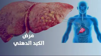 اكتشاف جيني جديد يغير علاج الكبد الدهني دون حاجة لأنظمة غذائية صارمة