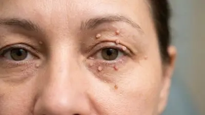 الزوائد الجلدية حول العين: الأسباب ووصفات طبيعية علاجية