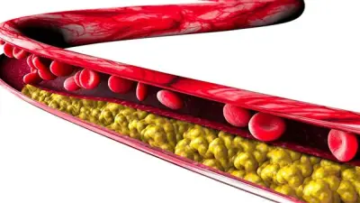 أعراض ارتفاع الدهون الثلاثية بالجسم وطرق علاجها