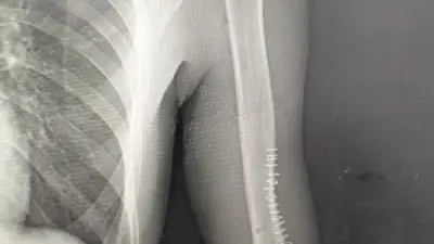 نجاح أول جراحة دقيقة لتصحيح تشوه مفصل المرفق بمستشفى الغردقة العام