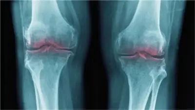 مفاجأة علمية: اكتشاف مذهل يجدد الغضروف ويعالج المفاصل