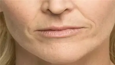 وصفة طبيعية لعلاج الخطوط الرفيعة حول الفم بفعالية وأمان