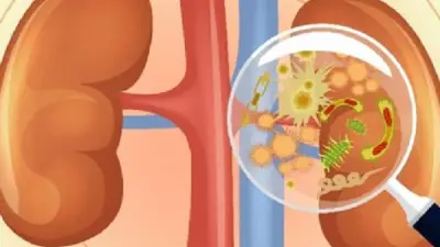 من الشوكولاتة إلى المكسرات.. أطعمة تزيد خطر حصى الكلى