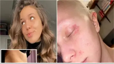 فتاة بريطانية تكتشف إصابتها بسرطان المبيض بعد أعراض خادعة