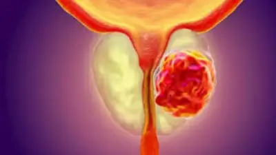 علامات تحذيرية لسرطان البروستاتا.. لا تتجاهلها
