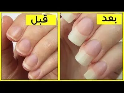 طرق فعالة لعلاج تقصف الأظافر واستعادة جمالها وقوتها