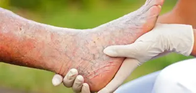 طرق طبيعية لعلاج دوالي القدمين بالأعشاب والخل