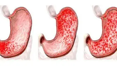التهاب المعدة: الأعراض والأسباب وطرق العلاج الفعالة