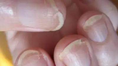 أسباب غير متوقعة وراء تقصف الأظافر وكيفية علاجها