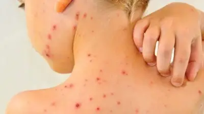 الجدري المائي يهاجم الأطفال: أعراض لا يجب تجاهلها وطرق الوقاية