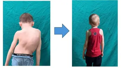 نجاح فريق طبي بجامعة أسيوط في علاج طفل من تشوه حاد بالعمود الفقري بتقنية حديثة