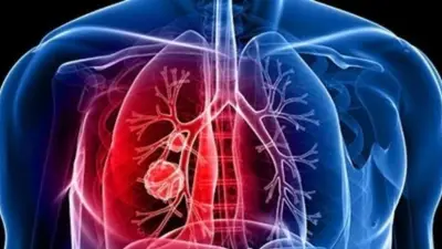 أكياس النيكوتين تسبب مرض رئة الفشار.. 5 أعراض تحذيرية