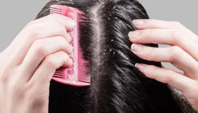 7 طرق طبيعية للتخلص من قشرة الرأس دون مستحضرات باهظة الثمن