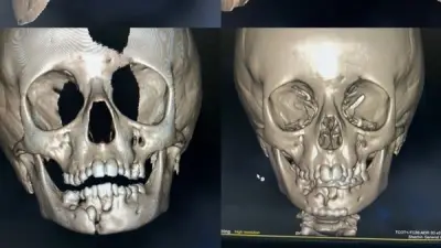 مستشفى شربين المركزي ينجح في جراحة دقيقة لفك طفل عمره 7 سنوات