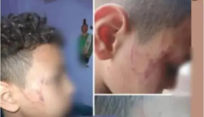 خدوش وسحجات بالوجه.. معلمة تعتدي على طالب في سوهاج