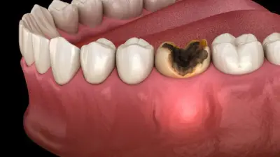 كيف تعالج أسنانك وتحشيها بأسعار رخيصة؟ دليل الوحدات الصحية الحكومية