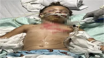 تحذير عاجل للآباء من ترند تيك توك: ألعاب الميكروويف تسبب حروقاً مؤلمة للأطفال