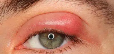 مع تقلب الجو.. تعرف على طرق علاج تورم العين الفعالة