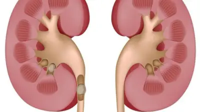 عامل خفي يزيد خطر الإصابة بأمراض الكلى.. الهواء الملوث