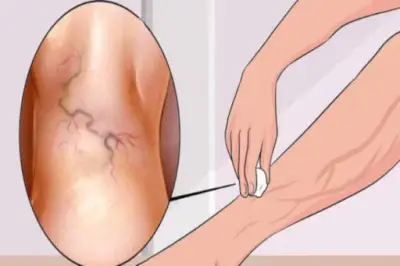 أربعة أعشاب طبيعية لعلاج دوالي القدمين والساقين