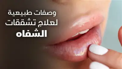 وصفات سريعة لترطيب الشفاه الجافة في الحر والصيام