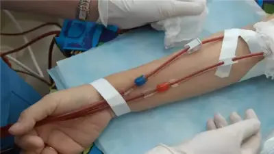 هل يمكن تأخير الغسيل الكلوي؟ استشاري يوضح العوامل المؤثرة