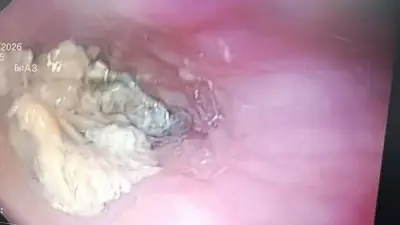 إنقاذ مريض من انسداد حاد بالمريء بعد انحشار الطعام في حلقه بمستشفى بنها