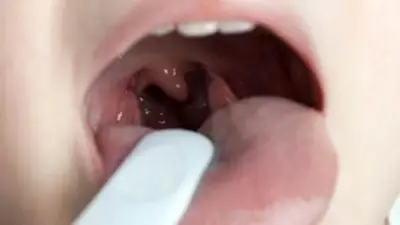 التهاب الحلق: الأعراض والأسباب وطرق العلاج بالأعشاب