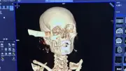 قصر العيني ينجح في استخراج سكين من جمجمة مريضة في عملية نادرة