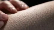 هل القشعريرة المتكررة علامة خطر؟ تعرف على أسبابها المفاجئة