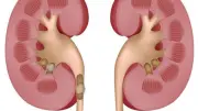 عامل خفي يزيد خطر الإصابة بأمراض الكلى.. الهواء الملوث