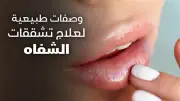 وصفات سريعة لترطيب الشفاه الجافة في الحر والصيام